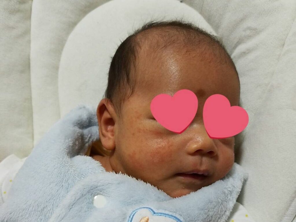 赤ちゃんの頃 脱ステロイドに挑戦したけど挫折した話 体験談 Take Log